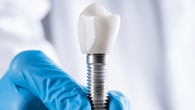 dental implants webster groves mo