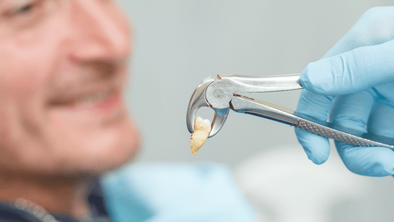 tooth extraction