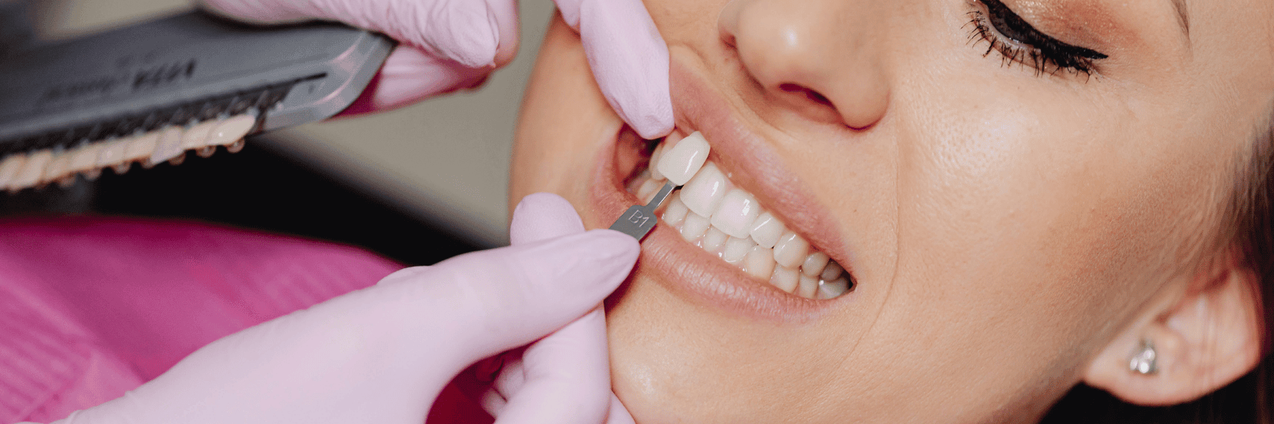 patient receiving porcelain veneers at Webster Groves Dental