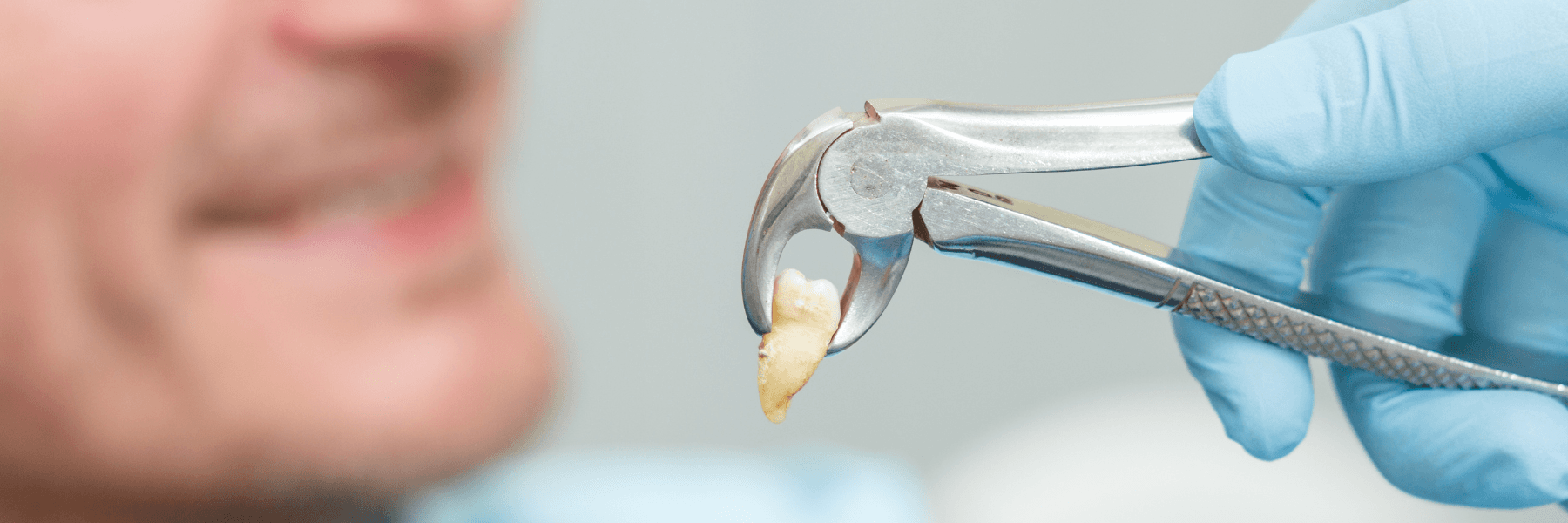 tooth extraction