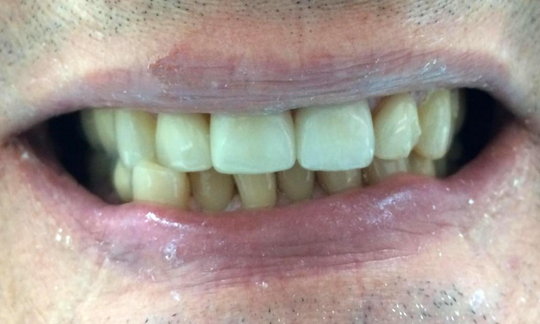 Results from placement of dental crown and porcelain veneers in Webster Groves