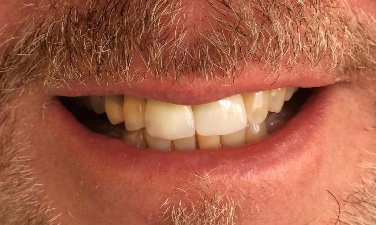 Front-Tooth-Dental-Implant-After-Image
