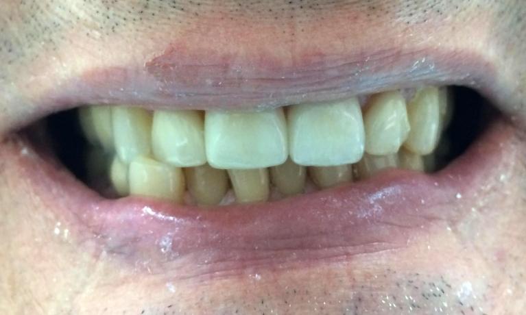 Two-front-top-teeth-crown-and-veneer-After-Image
