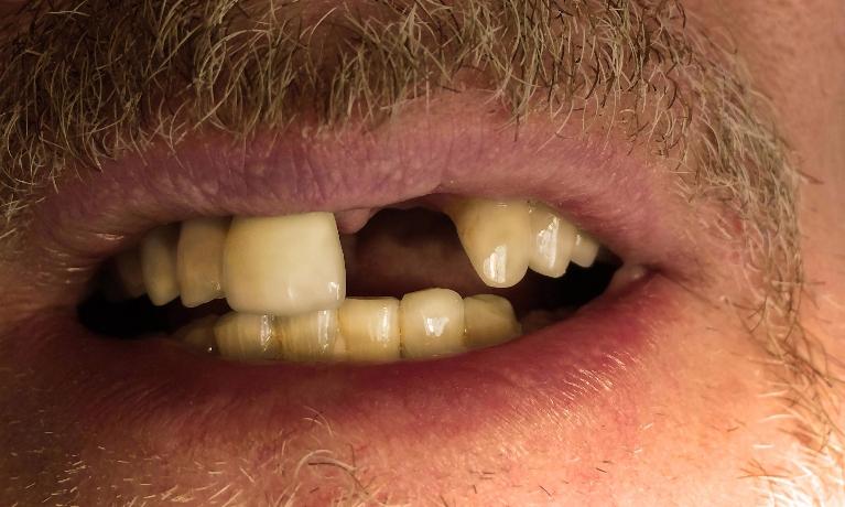 Front-Tooth-Dental-Implant-Before-Image