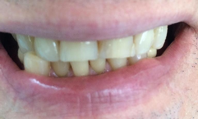 Two-front-top-teeth-crown-and-veneer-Before-Image