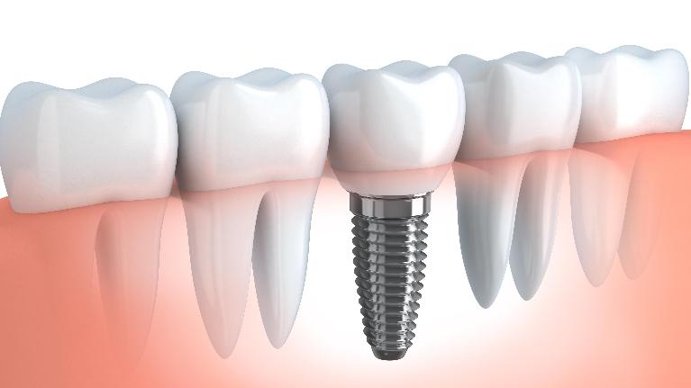 3 Big Benefits of Dental Implants