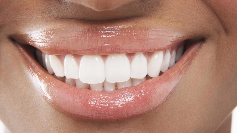 Boost Your Confidence With Dental Veneers