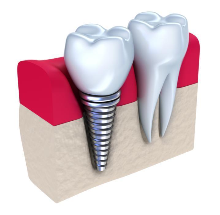 Dental Implant Next to Normal Tooth Roots